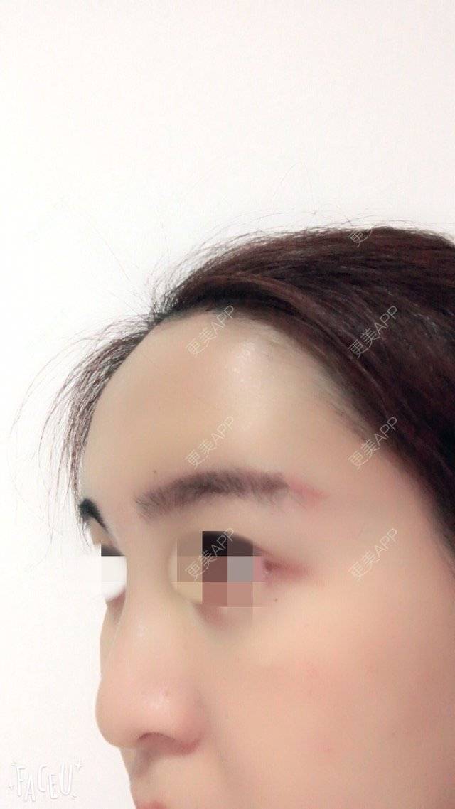 更美 - 泡泡猪猪的经验 | 美购日记 | 上臂吸脂 | 自体脂肪填充额头 | 深圳