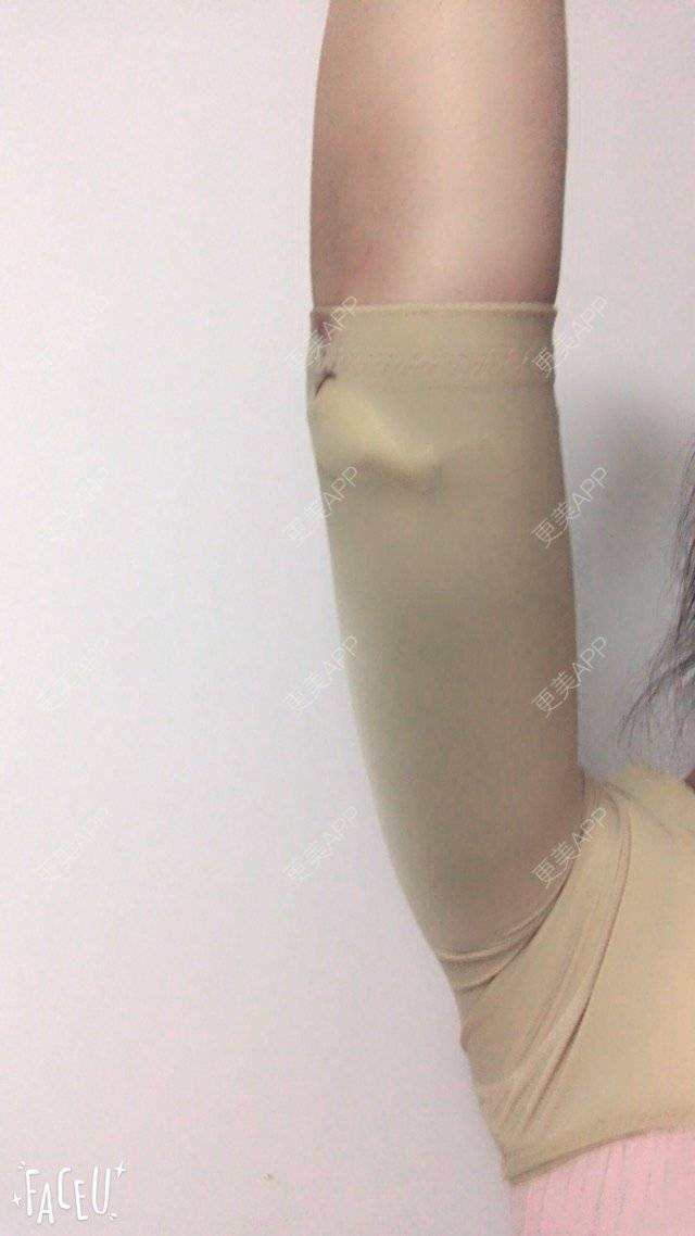 更美 - 泡泡猪猪的经验 | 美购日记 | 上臂吸脂 | 自体脂肪填充额头 | 深圳
