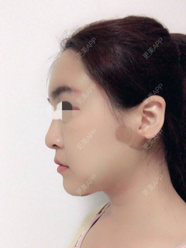更美 - 泡泡猪猪的经验 | 美购日记 | 上臂吸脂 | 自体脂肪填充额头 | 深圳