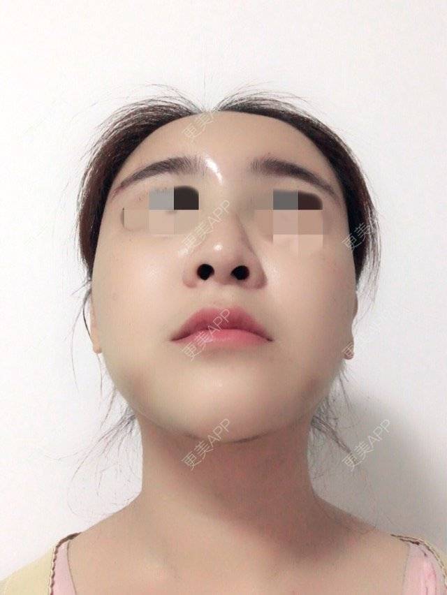 更美 - 泡泡猪猪的经验 | 美购日记 | 上臂吸脂 | 自体脂肪填充额头 | 深圳