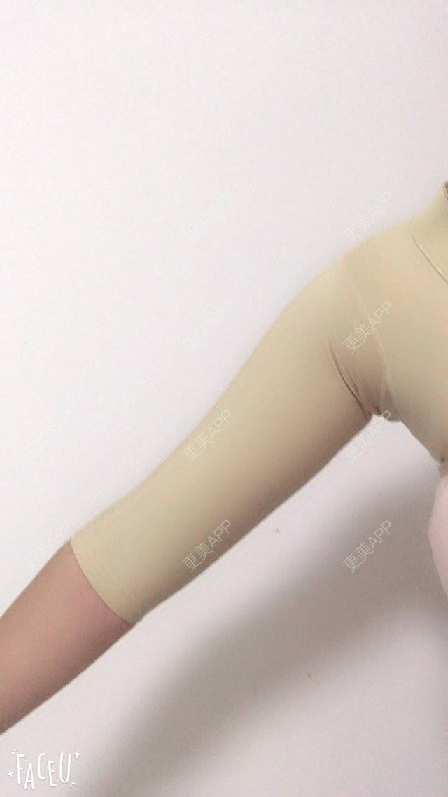 更美 - 泡泡猪猪的经验 | 美购日记 | 上臂吸脂 | 自体脂肪填充额头 | 深圳