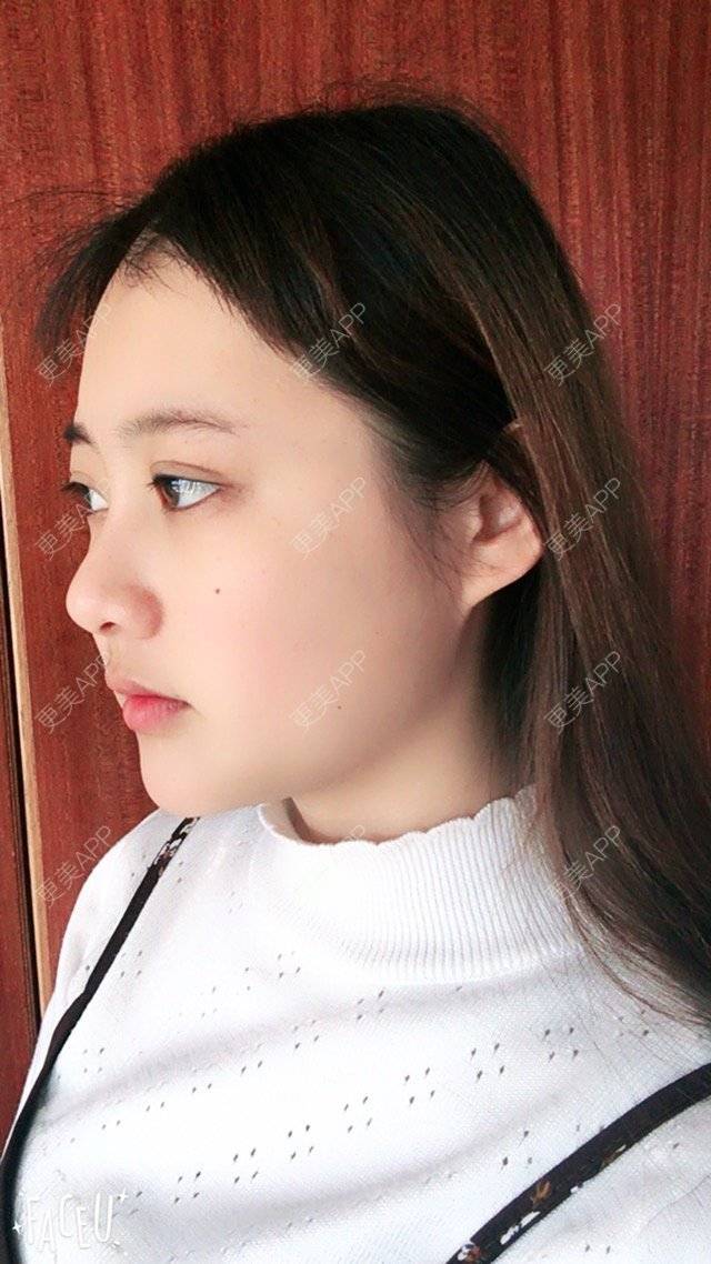 更美 - 用户13543729的经验 | 在线面诊21 | 脸部轮廓 | 广州