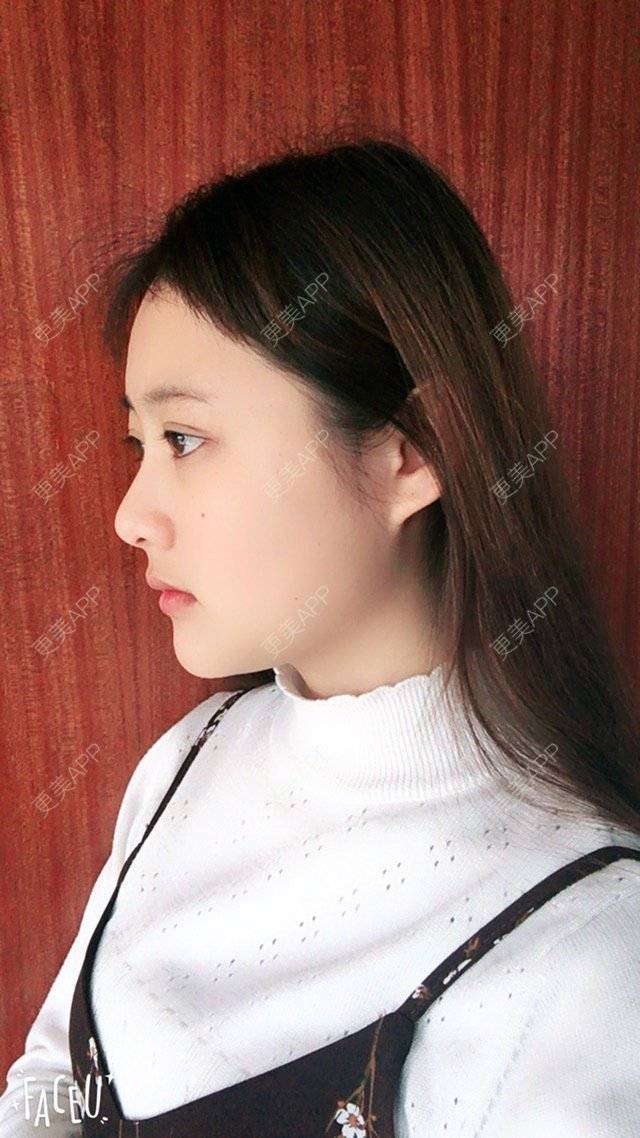 更美 - 用户13543729的经验 | 在线面诊21 | 脸部轮廓 | 广州