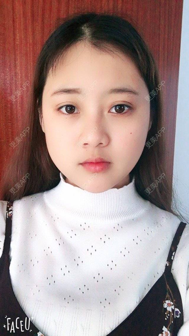 更美 - 用户13543729的经验 | 在线面诊21 | 脸部轮廓 | 广州