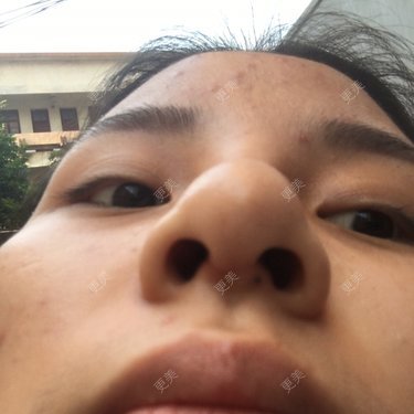 鼻小柱旁边靠近鼻翼旁边出现了白色东西请问是增生还是肋骨要穿出来了