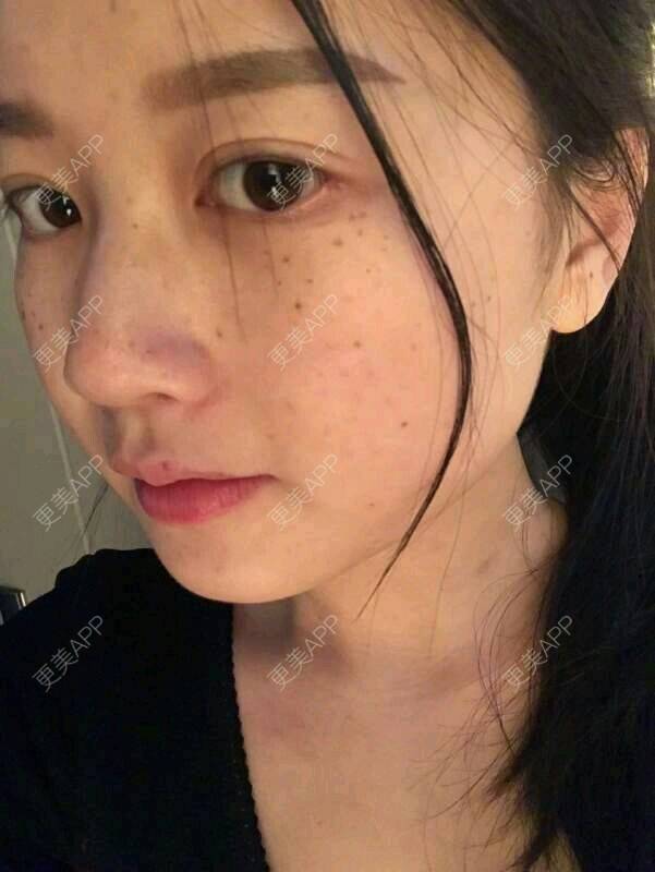 青青河边花的激光淡斑日记