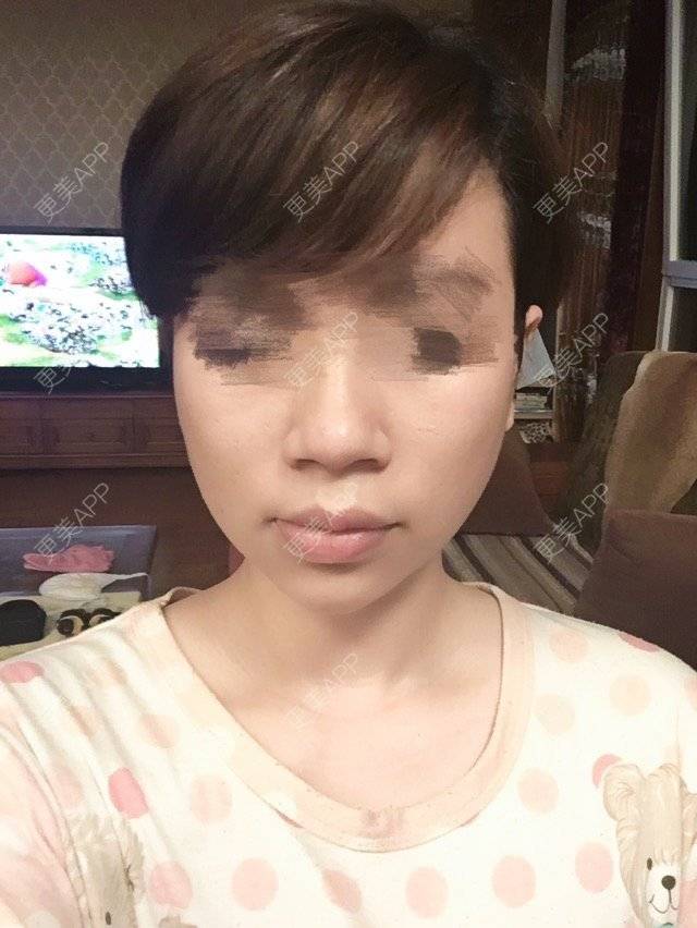 更美 - 不想睡觉的豆豆的经验 | 牙齿矫正 | 假体垫下巴 | 下厚唇改薄 | 东营