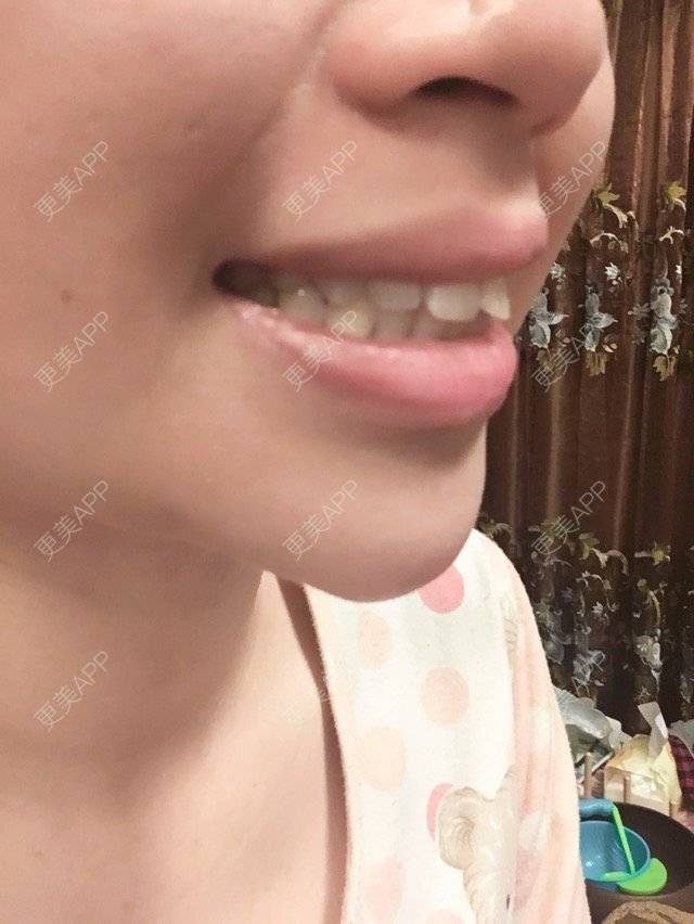 更美 - 不想睡觉的豆豆的经验 | 牙齿矫正 | 假体垫下巴 | 下厚唇改薄 | 东营