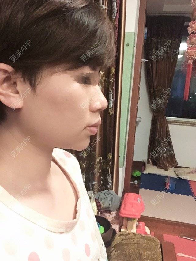 更美 - 不想睡觉的豆豆的经验 | 牙齿矫正 | 假体垫下巴 | 下厚唇改薄 | 东营