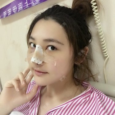 鼻骨内推