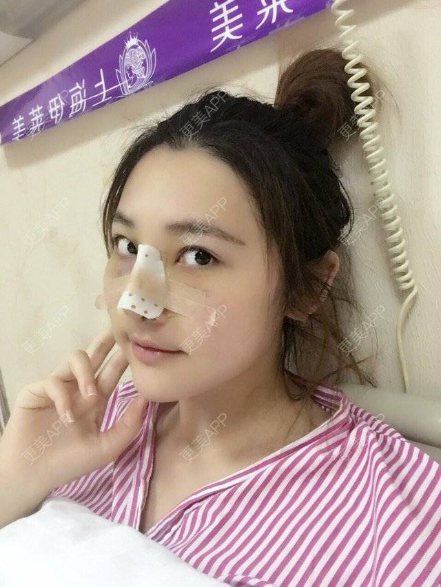更美 - Valkyrie Wong的经验 | 鼻骨内推 | 鼻综合手术 | 鼻部整形 | 南京