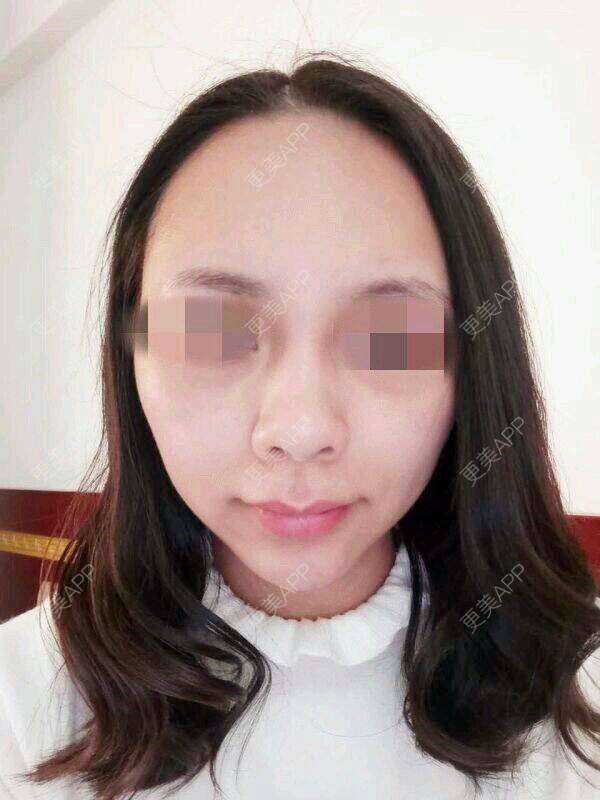 更美 - 更美用户VD6LtlLtiz的PRP自体血清美肤经验 | PRP自体血清美肤 | 脸部毛孔粗大 | 皮肤美容