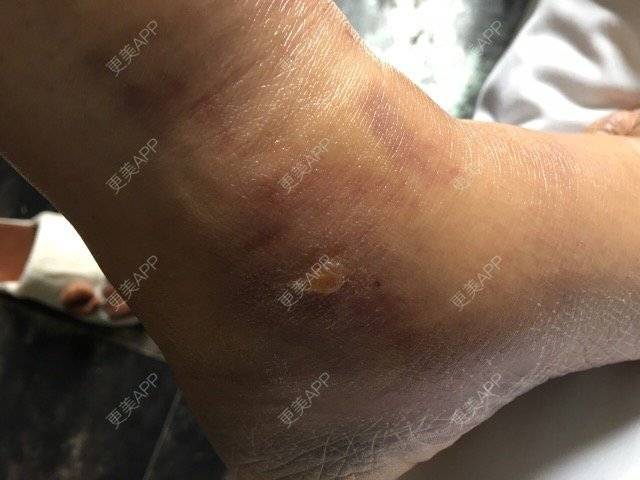 更美 - 更美用户4681813193的丰胸（隆胸）经验 | 美购日记 | 丰胸（隆胸） | 吸脂臀沟 | 郑州
