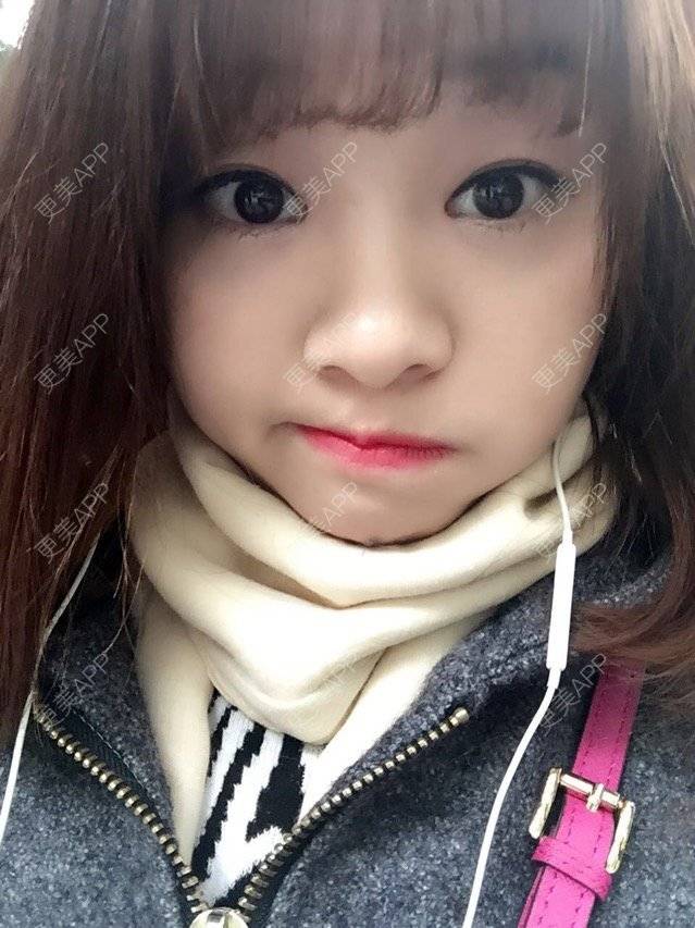 更美 - Mimo 兰的眼皮下垂矫正经验 | 上海 | 眼皮下垂矫正