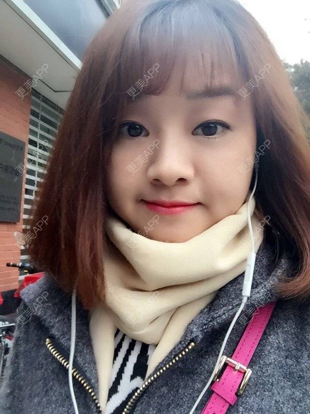 更美 - Mimo 兰的眼皮下垂矫正经验 | 上海 | 眼皮下垂矫正