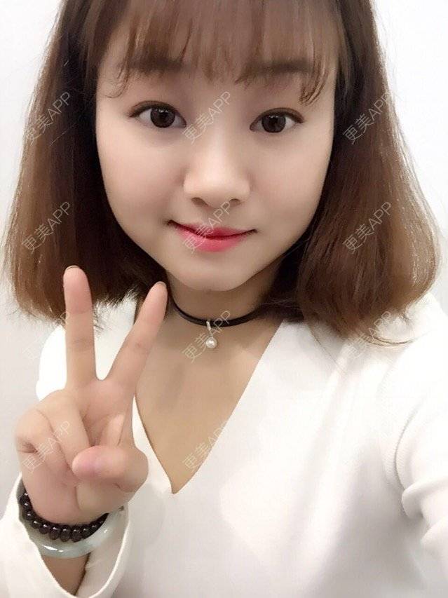 更美 - Mimo 兰的眼皮下垂矫正经验 | 上海 | 眼皮下垂矫正