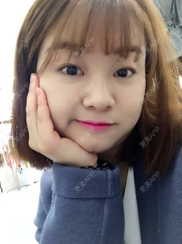 更美 - Mimo 兰的眼皮下垂矫正经验 | 上海 | 眼皮下垂矫正