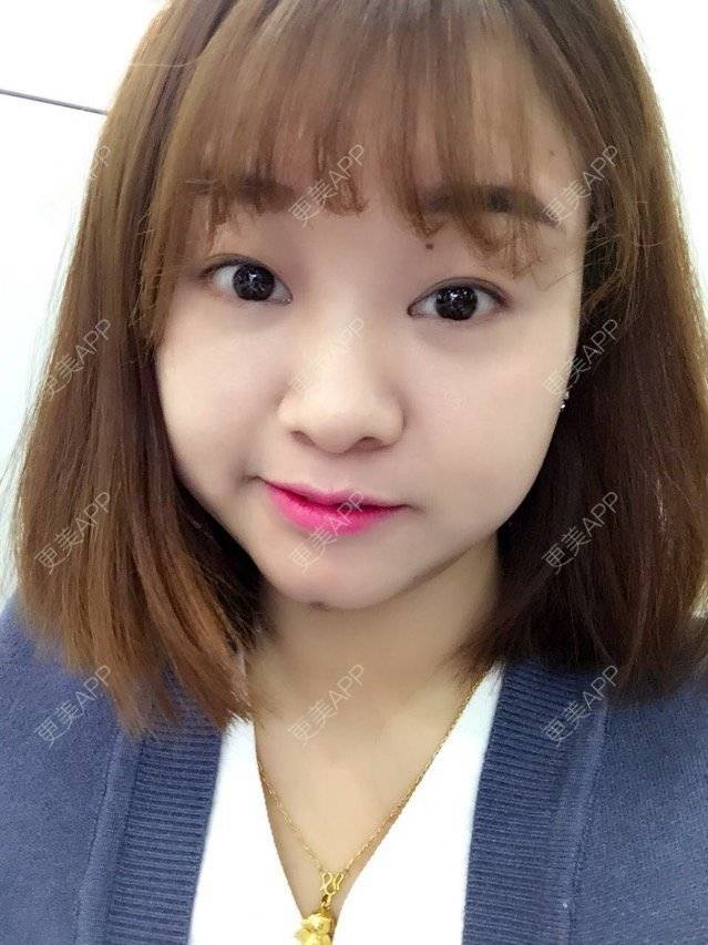 更美 - Mimo 兰的眼皮下垂矫正经验 | 上海 | 眼皮下垂矫正