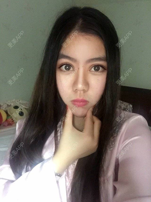 更美 - 夏惠清子的经验 | 鼻部整形 | 玻尿酸额头 | 沈阳