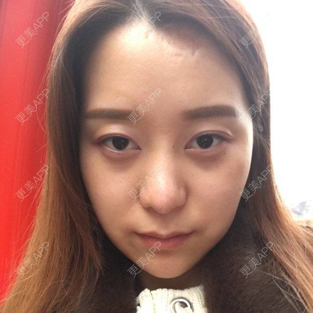 更美 - 更美用户wVlYdd2mdw的经验 | 去除疤痕 | 调整发际线 | 北京