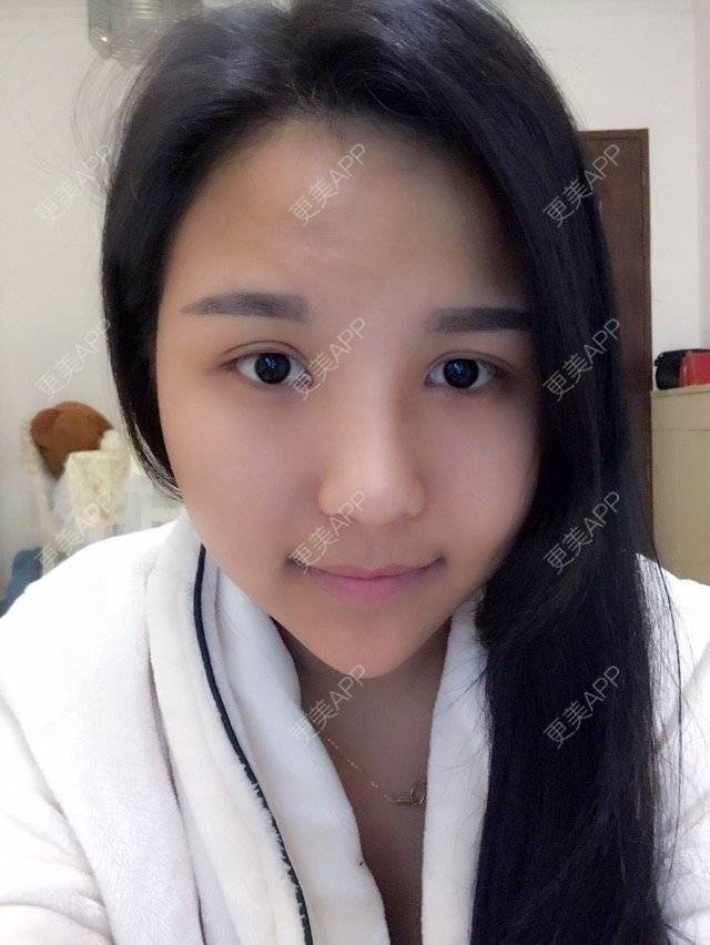 更美 - 🎀Ting     ༯的经验 | 吸脂瘦脸 | 深圳
