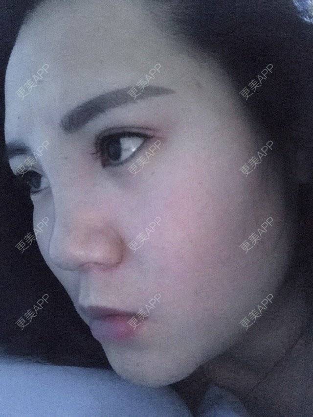 更美 - CC wang的经验 | 鼻部整形 | 玻尿酸垫鼻子 | 上海