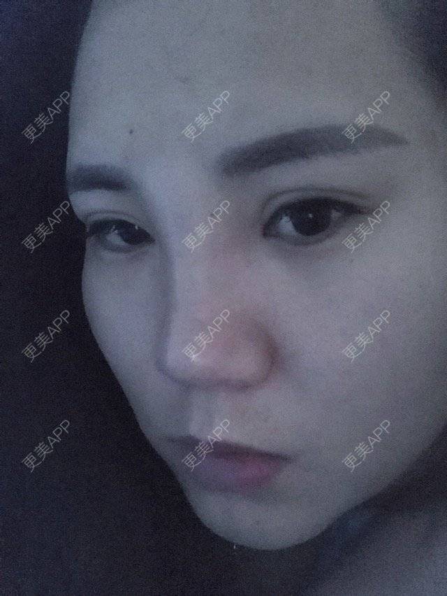 更美 - CC wang的经验 | 鼻部整形 | 玻尿酸垫鼻子 | 上海
