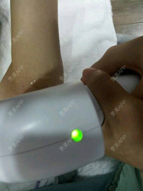 更美 - 甘蔗妹子的激光脱毛经验 | 美购日记 | 术后求抱抱 | 激光脱毛腋下 | 激光脱毛 | 武汉