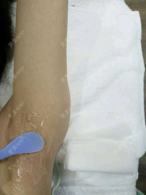 更美 - 甘蔗妹子的激光脱毛经验 | 美购日记 | 术后求抱抱 | 激光脱毛腋下 | 激光脱毛 | 武汉
