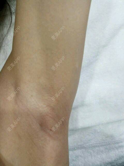更美 - 甘蔗妹子的激光脱毛经验 | 美购日记 | 术后求抱抱 | 激光脱毛腋下 | 激光脱毛 | 武汉