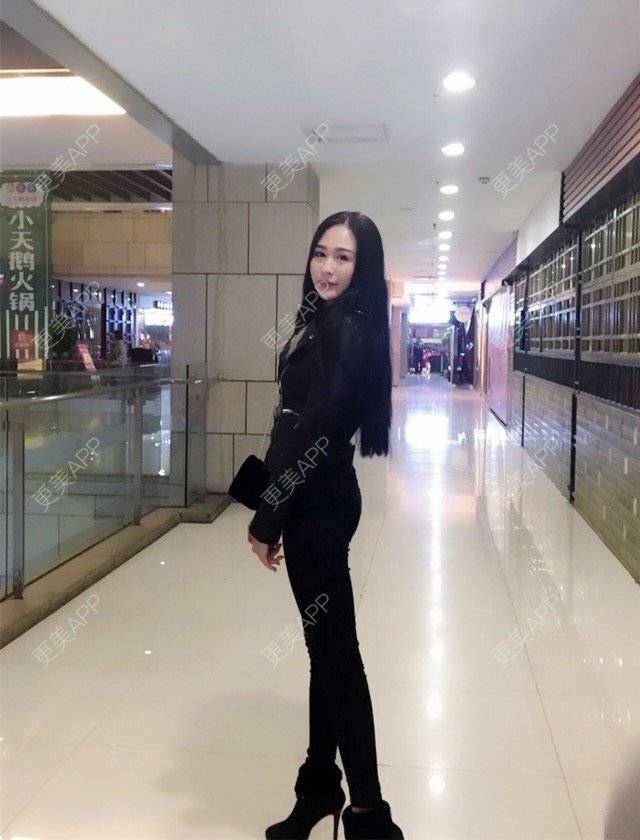 更美 - μ昕怡的吸脂经验 | 美购日记 | 抽脂塑形 | 腿部塑形 | 吸脂 | 重庆 | 视频日记