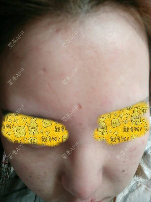 更美 - 宝哥😘的经验 | 面部红血丝 | 脸部毛孔粗大 | 脸部皮肤过敏 | 青岛