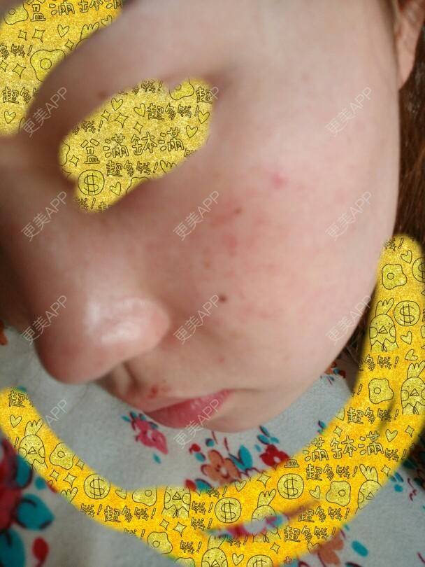 更美 - 宝哥😘的经验 | 面部红血丝 | 脸部毛孔粗大 | 脸部皮肤过敏 | 青岛