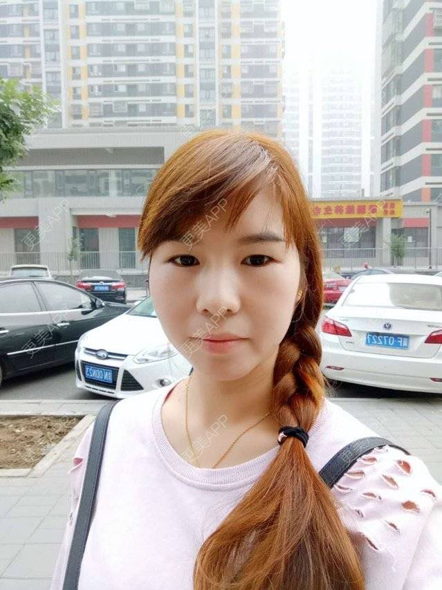 更美 - 更美用户HTHoFyr1vM的经验 | 自体脂肪面部年轻化 | 广州