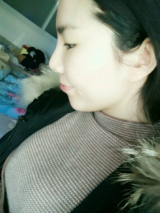 更美 - 蜕变知足常乐的自体脂肪全面部填充经验 | 美购日记 | 自体脂肪全面部填充 | 脂肪填充太阳太阳穴 | 丰脸颊 | 武汉