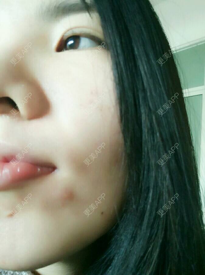 更美 - 蜕变知足常乐的自体脂肪全面部填充经验 | 美购日记 | 自体脂肪全面部填充 | 脂肪填充太阳太阳穴 | 丰脸颊 | 武汉