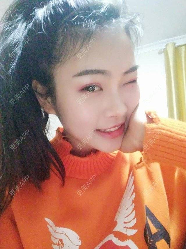 更美 - 早早我的经验 | 鼻部多项 | 双眼皮 | 荆州