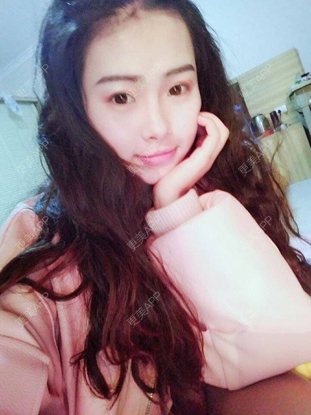 更美 - 早早我的经验 | 鼻部多项 | 双眼皮 | 荆州