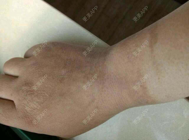 更美 - 更美用户WUstmpfo9y的经验 | 疤痕修复 | 南昌