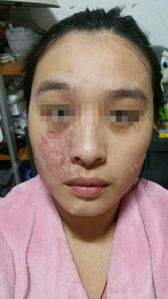 更美 - 更美用户kl7JuxRrp7的经验 | 美购日记 | 去鲜红斑痣 | 成都