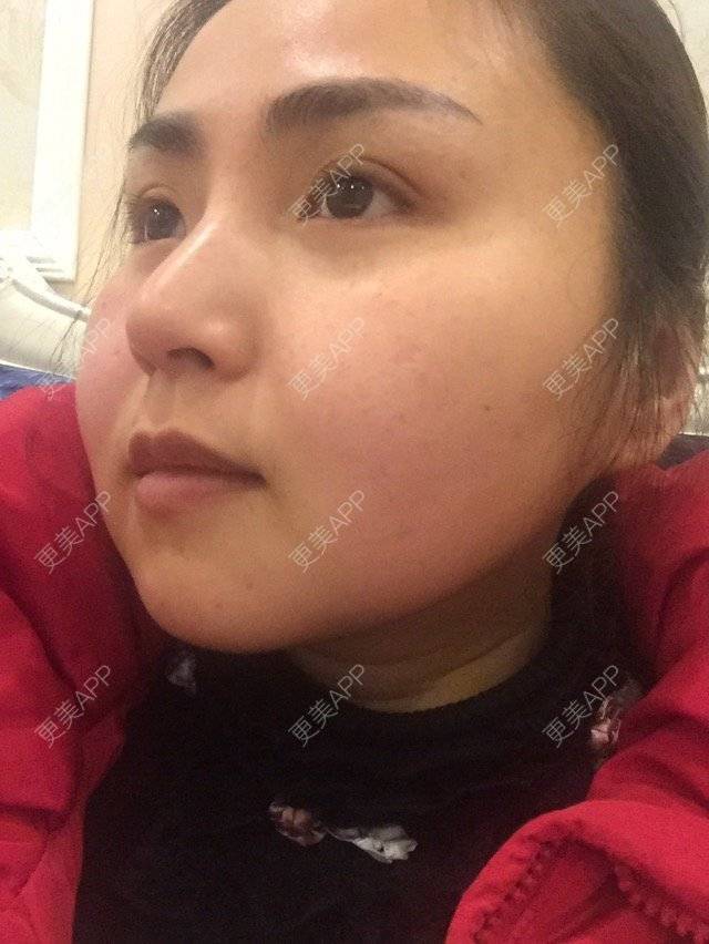 更美 - 榆榆的经验 | 脸部吸脂 | 成都