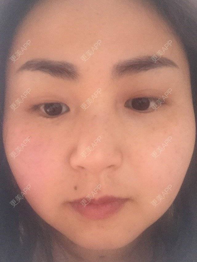 更美 - 榆榆的经验 | 脸部吸脂 | 成都