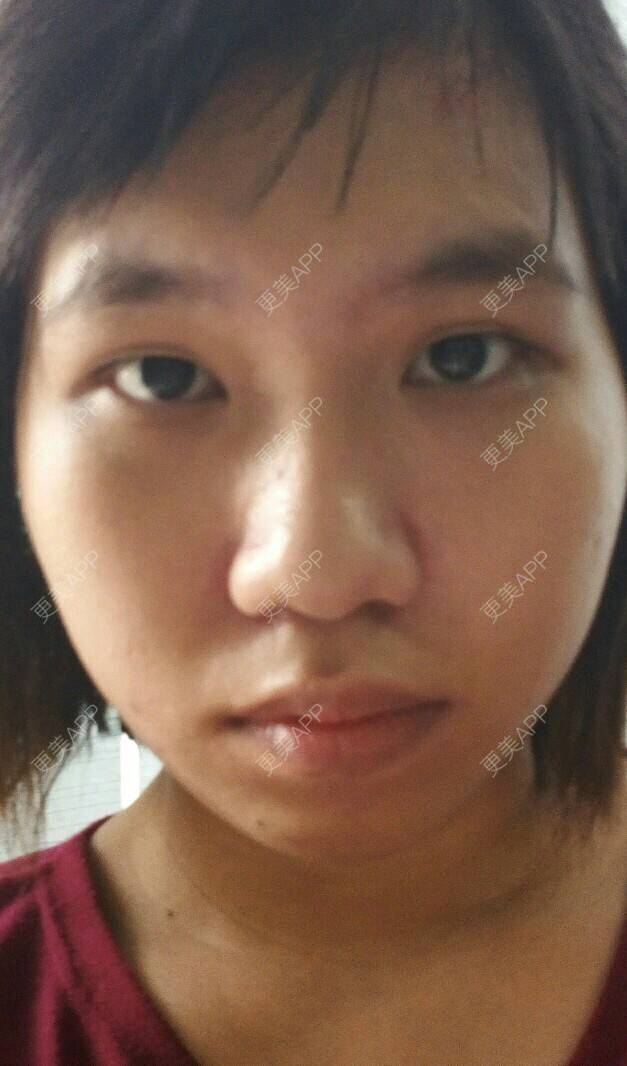 更美 - Helena樱的经验 | 颧骨颧弓 | 玻尿酸太阳 | 宽下巴矫正 | 新加坡直辖市