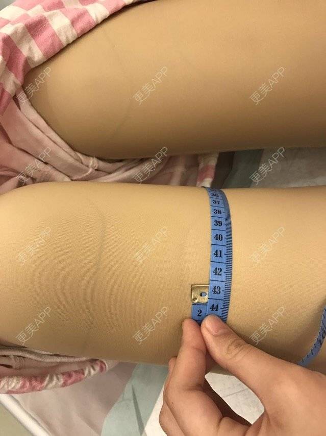 更美 - 囍宝2333的吸脂经验 | 美购日记 | 吸脂 | 吸脂臀沟 | 吸脂大腿 | 重庆