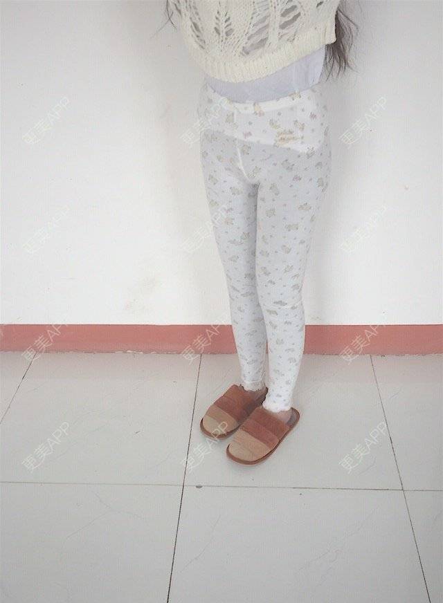 更美 - 慢漫曼小姐的吸脂瘦大腿经验 | 宁波 | 吸脂瘦大腿