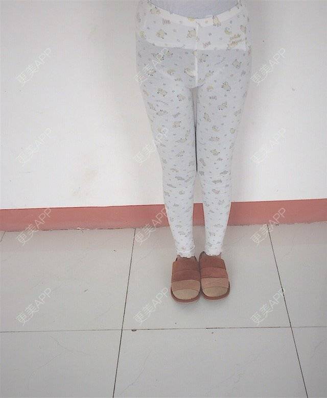 更美 - 慢漫曼小姐的吸脂瘦大腿经验 | 宁波 | 吸脂瘦大腿