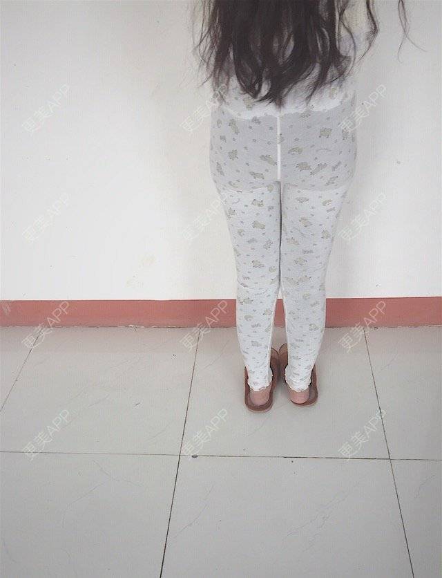 更美 - 慢漫曼小姐的吸脂瘦大腿经验 | 宁波 | 吸脂瘦大腿