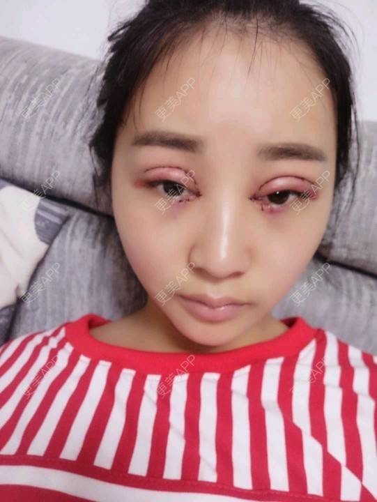 全切双眼皮效果图_dm后知后觉l_7067全切双眼皮效果图_术后285天__更