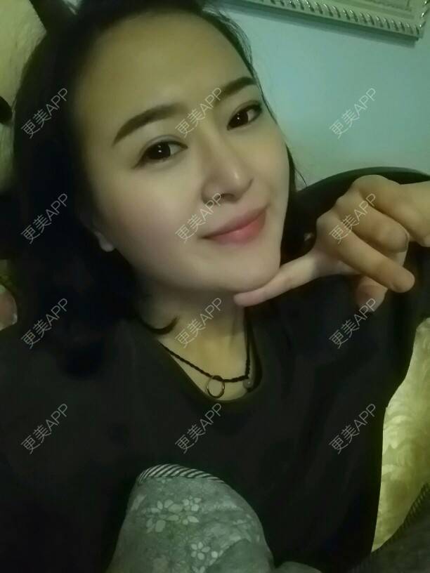 更美 - 종로페페 👧 👧的经验 | 整形模拟器 | 自体脂肪垫下巴 | 修复双眼皮 | 衡阳