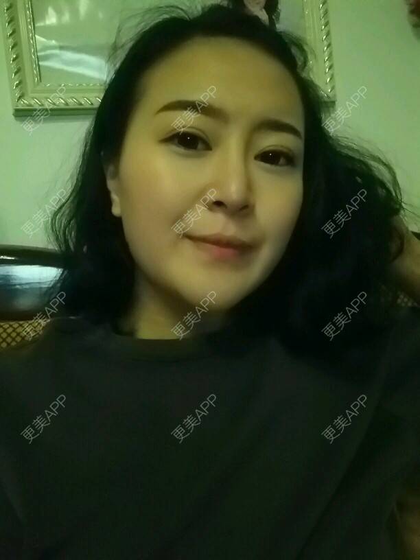 更美 - 종로페페 👧 👧的经验 | 自体脂肪垫下巴 | 全切双眼皮修复 | 衡阳